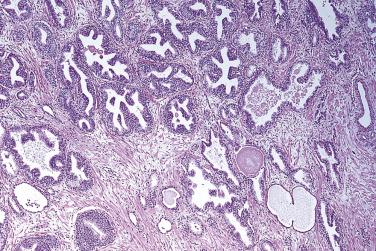 FIG. 14A.1, Prostatic intraepithelial neoplasia (PIN). The glandular structures of PIN have a complex architecture featuring epithelial proliferation and nuclear stratification. The affected glands that make up the thickened cellular walls stand out over the normal or atrophic glands.