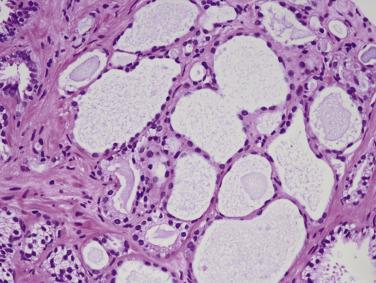 FIG. 14A.105, Partial atrophy with scanty luminal cytoplasm.