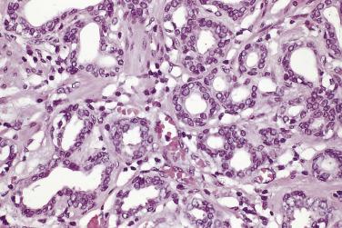 FIG. 14A.106, A higher magnification of simple lobular atrophy. The atrophic glands are lined by uniform cells with hyperchromatic nuclei. Nucleoli are usually absent or inconspicuous.