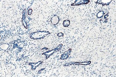 FIG. 14A.107, Basal cell–specific keratin 34βE12 (K903) immunostaining shows the preservation of basal cells in the atrophic glands.