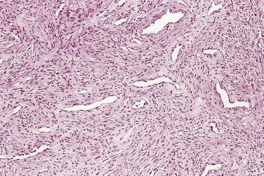 FIG. 14A.112, A stromal nodule is characterized by vascular and spindle cell proliferation. The spindle cells are arranged in a whorled pattern around blood vessels.