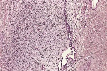 FIG. 14A.116, Phyllodes tumor. A biphasic pattern with glandular and stromal proliferation characterizes this lesion.