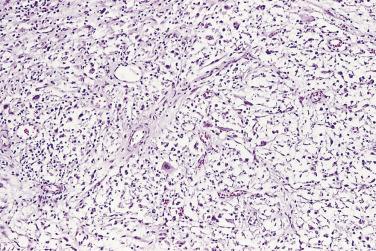 FIG. 14A.118, Pseudosarcomatous fibromyxoid tumor. The myxoid stroma contains spindle cells, small slitlike blood vessels, and inflammatory cells, mainly lymphocytes and plasma cells.