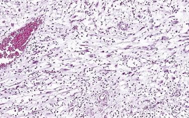 FIG. 14A.119, Pseudosarcomatous fibromyxoid tumor. Some bizarre cells with one or two large nuclei and dense eosinophilic cytoplasm are present.