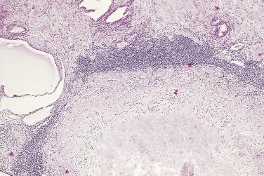 FIG. 14A.120, An ovoid, large, well-circumscribed granuloma with a dense band of palisading histiocytes surrounds a necrotic center. At the periphery is a dense zone of inflammatory cells comprising predominantly lymphocytes and plasma cells.