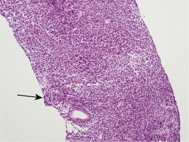 FIG. 14A.125, Diffuse infiltration of small lymphoid cells in the prostatic stroma and occasional lymphoepithelial island (arrow).