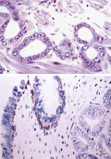 FIG. 14A.17, (A) To confirm the diagnosis of prostate cancer, the cells in the suspicious glands must show nuclear enlargement with prominent nucleoli and absence of basal cells. (B) This illustration depicts small glands of carcinoma with no basal cells, whereas the adjacent high-grade prostatic intraepithelial neoplasia reveals prominent basal cells.