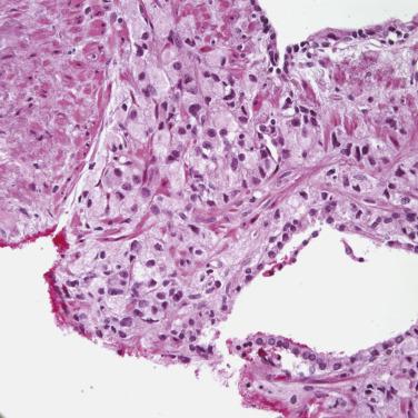 FIG. 14A.20, Solid form of foamy gland carcinoma in prostate biopsy.