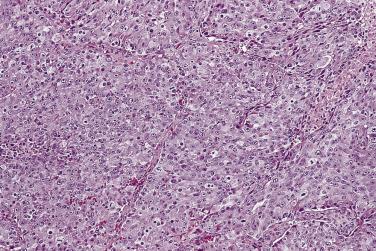 FIG. 14A.24, High-grade solid prostatic adenocarcinoma. A high-grade prostatic adenocarcinoma may be confused with high-grade urothelial carcinoma, but prostate carcinoma usually shows a monotonous appearance of the tumor cells.