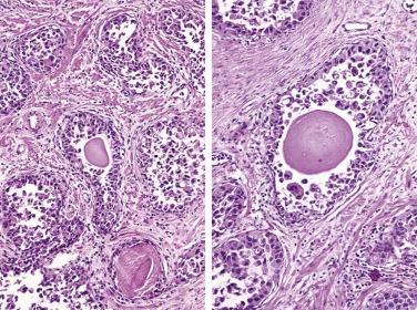 FIG. 14A.25, Urothelial carcinoma involving prostatic ducts. In these illustrations the acinar structures are expanded by a proliferation of high-grade malignant pleomorphic cells. Note the presence of corpora amylacea within the lumina of the acinar structures. The tumor cells are far more pleomorphic and mitotically active than expected for a high-grade adenocarcinoma of the prostate.