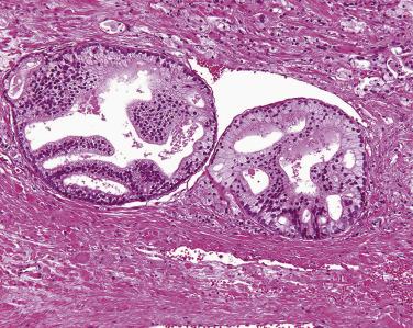 FIG. 14A.3, Foamy high-grade prostatic intraepithelial neoplasia (PIN). PIN cells have abundant foamy cytoplasm, which is better depicted on the upper aspect of the glands.