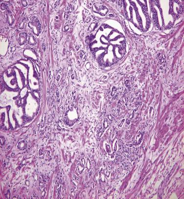 FIG. 14A.36, Prostate cancer with mixed Gleason pattern 4, cribriform type and Gleason pattern 3B. This tumor shows focal papillary or cribriform pattern, formerly considered pattern 3C, now recognized as pattern 4 regardless of the size of cribriform glands.