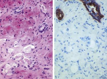 FIG. 14A.45, Radiation treatment effect in prostate cancer. Left, Two or three glands lined by hyperchromatic nuclei, and several distorted small glands. Right, Absence of basal cells in the carcinomatous area, in contrast to basal cell–lined benign glands (upper) highlighted by high molecular weight cytokeratin.