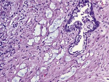 FIG. 14A.48, Hormone-treated prostate cancer. Adjacent to the large benign gland with prominent basal cells are distorted and dilated glandular structures lined by a flattened epithelium and filled with mucinous material. Extravasated mucin pools are seen in the stroma that closely mimic pseudomyxoma ovarii. In addition, isolated small clusters of tumor cells are present infiltrating diffusely in the stroma.