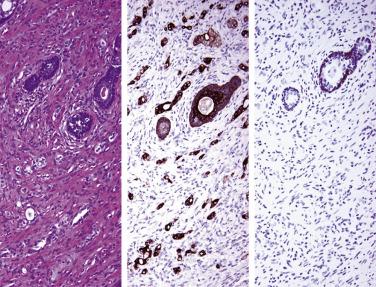 FIG. 14A.49, Immunostaining in hormone-treated prostate cancer. A high-power image of Fig. 14A.46 (left) shows isolated and small clusters of tumor cells which (center) are positive for pancytokeratin but are negative for high molecular weight cytokeratin (right). Note positively stained basal cells in atrophic normal glands.