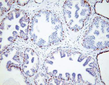 FIG. 14A.5, High-grade prostatic intraepithelial neoplasia (PIN) glands frequently show partial loss of basal cells. Note skipped nuclear staining. Compare this illustration with the complete basal cell stain of low-grade PIN in Fig. 14A.4 .