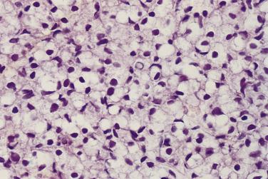 FIG. 14A.53, Signet ring cell carcinoma. These tumor cells are characterized by clear cytoplasm and peripherally displaced nuclei.