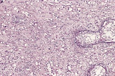 FIG. 14A.55, Hormonal treatment can cause cytoplasmic clearing of tumor cells that may resemble signet ring cell carcinoma. Note the squamous metaplasia in the benign prostatic glands.