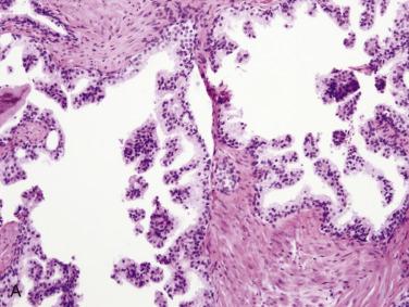 FIG. 14A.6, (A) Large glands with luminal complexity, resembling high-grade prostatic intraepithelial neoplasia (central zone gland). (B) Diagnostic scheme for large cribriform gland lesion.