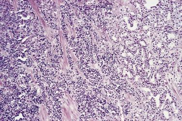 FIG. 14A.61, Small cell carcinoma is present (left) and a usual adenocarcinoma (right) .