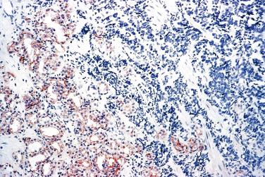 FIG. 14A.62, Immunostaining for prostate-specific antigen and prostatic acid phosphatase is positive in the adenocarcinoma component, but it is usually negative in the small cell carcinoma component.
