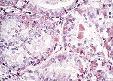 FIG. 14A.63, Tumor glands are focally lined by granulated cells resembling Paneth cells.