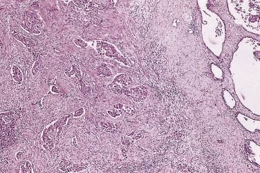 FIG. 14A.66, Direct extension of prostate by invasive urothelial carcinoma (UC) of urinary bladder. Prostatic stroma is involved by UC. Note the normal prostatic glands on the right.