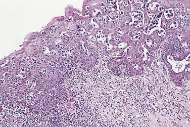 FIG. 14A.67, Urothelial carcinoma extends intraepithelially within the squamous epithelium of the urethral meatus.