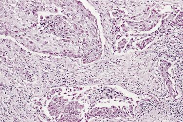 FIG. 14A.68, Urothelial carcinoma usually shows a solid growth pattern with frequent tumor necrosis, a high mitotic rate, and nuclear pleomorphism.