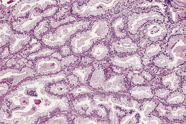 FIG. 14A.71, Atypical adenomatous hyperplasia (small gland hyperplasia). A proliferation of small glands with back-to-back arrangement. Prominent nucleoli are not seen.