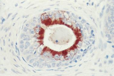 FIG. 14A.76, Incomplete basal cell hyperplasia showing prostate-specific antigen (PSA) immunoreactivity in the luminal secretory cells. Note the absence of PSA staining in the basal cells.