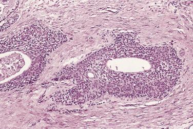 FIG. 14A.78, Transitional cell metaplasia, usually seen in the periurethral areas of the prostate. The cells of transitional cell metaplasia are larger and have more cytoplasm than those of basal cell hyperplasia.