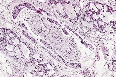 FIG. 14A.80, Adenoid cystic carcinoma. A cribriform pattern of adenoid cystic carcinoma with perineural invasion is seen.