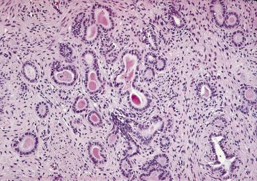 FIG. 14A.88, Classic mesonephric hyperplasia. This is a small-gland proliferation with small and larger glands lined by hyperchromatic nuclei. Pink secretions are present, and the stroma is reactive.