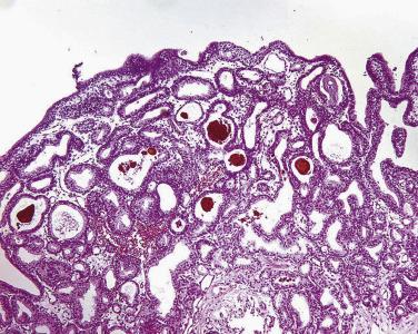 FIG. 14A.90, Verumontanum mucosal gland hyperplasia. This is a proliferation of small to midsize glands with inconspicuous basal cells. There is also a golden-brown type of intraluminal secretion.