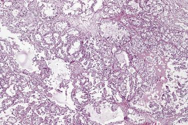 FIG. 14A.93, Clear cell adenocarcinoma. This low-magnification photograph shows a cellular tumor with tubular and papillary configuration.