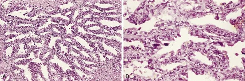 FIG. 14A.96, (A) A seminal vesicle with a small acinar configuration. The main characteristics of seminal vesicles include scattered pleomorphic nuclei (monster cells) and golden-brown lipofuscin pigment in the cytoplasm. (B) Higher magnification reveals monster cells and golden-brown lipofuscin pigment.