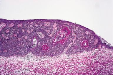 Figure 3.1, Seborrheic keratosis with mild pigmentation in the skin of a senior pathologist. Pseudohorny cysts are evident.