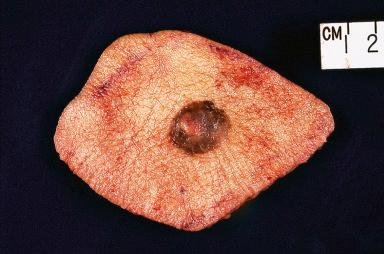 Figure 3.11, Gross appearance of basal cell carcinoma of forehead. The lesion is nodular and pigmented.