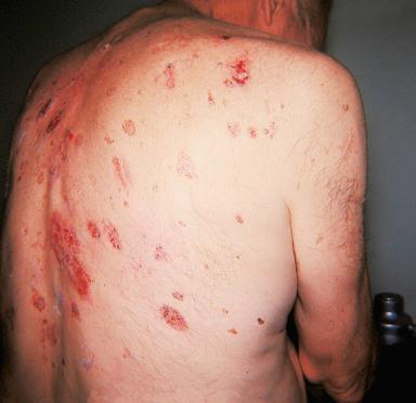 Figure 3.12, Multiple basal cell carcinomas in the skin of the back of an elderly patient.