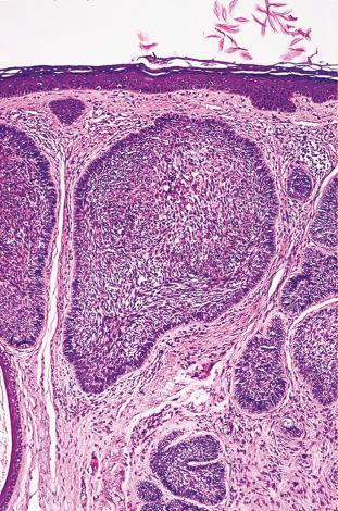 Figure 3.13, Typical nodular appearance with peripheral palisading of cutaneous basal cell carcinoma.