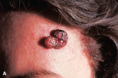 Figure 3.14, A and B, Clinical and microscopic appearance of pigmented basal cell carcinoma. Melanin is largely present in macrophages located in the stroma between tumor lobules.