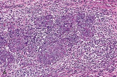 Figure 3.16, A and B, Low- and high-power views of lymphoepithelioma-like carcinoma.