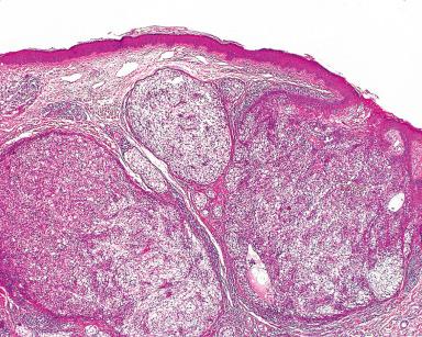 Figure 3.18, Hidradenoma.