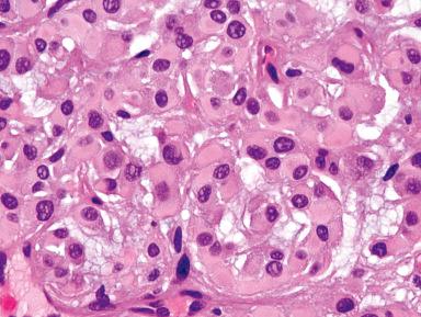 Figure 3.20, Myoepithelioma of skin consistent with sweat gland origin. The tumor cells have a typical hyaline cytoplasm.