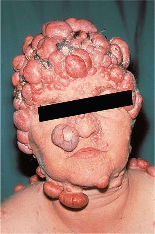 Figure 3.21, Clinical appearance of multiple dermal eccrine cylindroma extensively involving the scalp and other sites of the head and neck. This is sometimes referred to as turban tumor.