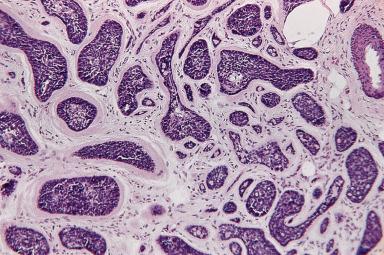 Figure 3.22, Eccrine Dermal Cylindroma.