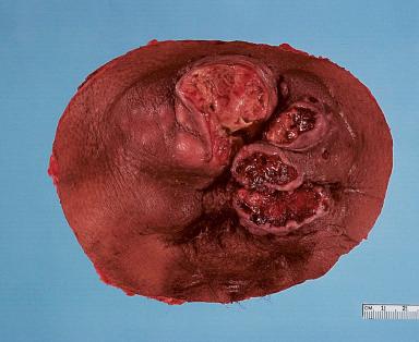 Figure 3.26, Gross appearance of resected specimen of sweat gland carcinoma of the axilla. The tumor grows in a multinodular fashion and shows several areas of ulceration.