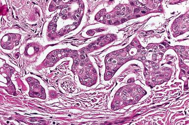 Figure 3.27, Typical branching configuration of sweat gland carcinoma.