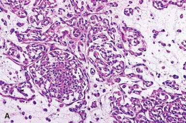 Figure 3.28, A and B, Sweat gland carcinoma of myoepithelial type located in the toe.